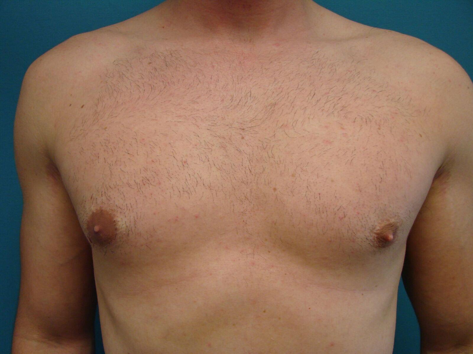 Handal Plastic Surgery gynecomastia after — Boca Raton, FL