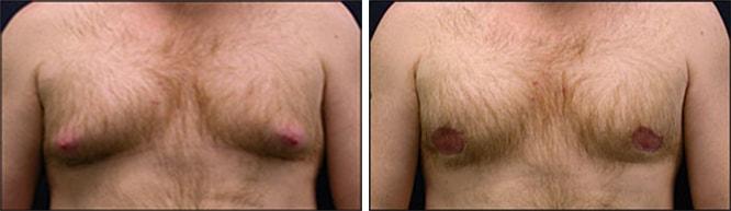 Speron Plastic Surgery gynecomastia result — Niles, IL