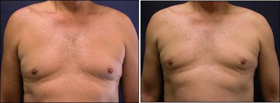 Speron Plastic Surgery gynecomastia result — Niles, IL