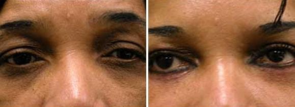 Speron Plastic Surgery eyelid lift result — Niles, IL