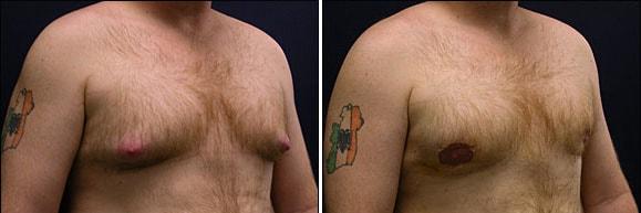 Speron Plastic Surgery gynecomastia result — Niles, IL