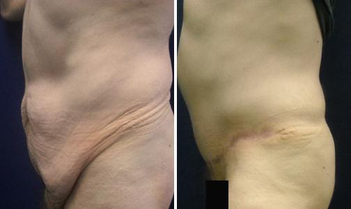 Tummy Tuck result at Speron Plastic Surgery in Niles, IL