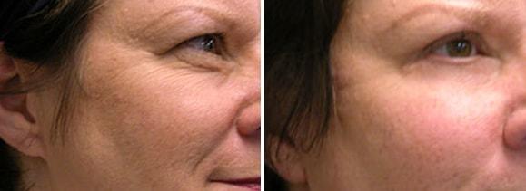 Speron Plastic Surgery eyelid lift result — Niles, IL