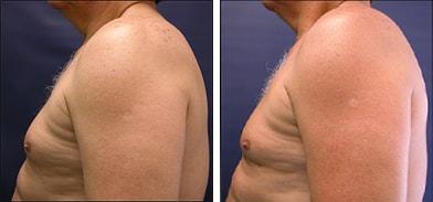 Speron Plastic Surgery gynecomastia result — Niles, IL