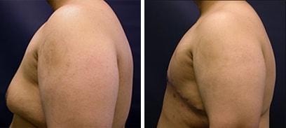 Speron Plastic Surgery gynecomastia result — Niles, IL