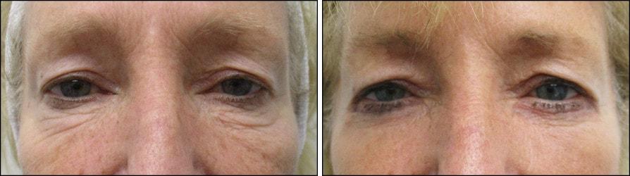 Speron Plastic Surgery eyelid lift result — Niles, IL