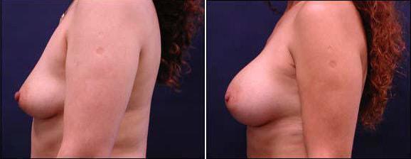 Breast Augmentation result at Speron Plastic Surgery in Niles, IL
