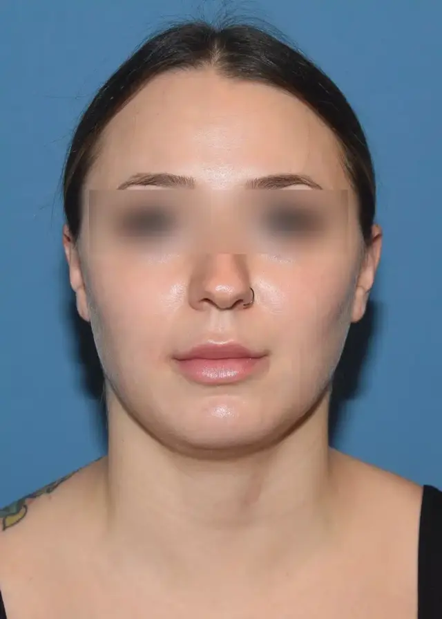 Liposuction result at Chicago Breast & Body Aesthetics in Chicago, IL