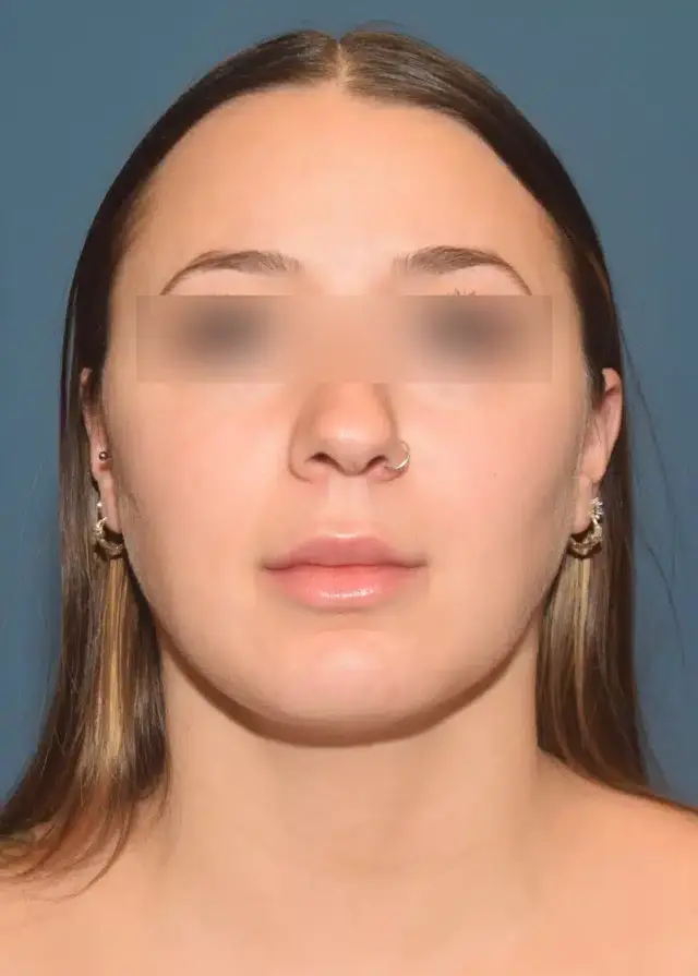 Liposuction result at Chicago Breast & Body Aesthetics in Chicago, IL