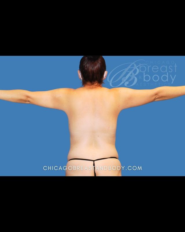Liposuction before at Chicago Breast & Body Aesthetics in Chicago, IL
