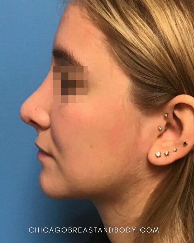 Functional Rhinoplasty after at Chicago Breast & Body Aesthetics in Chicago, IL