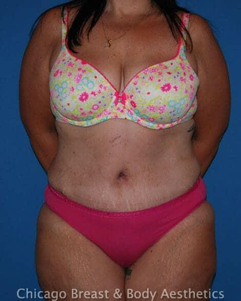 Tummy Tuck result at Chicago Breast & Body Aesthetics in Chicago, IL