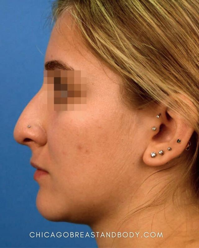 Functional Rhinoplasty before at Chicago Breast & Body Aesthetics in Chicago, IL