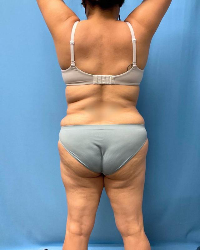 Liposuction result at Chicago Breast & Body Aesthetics in Chicago, IL