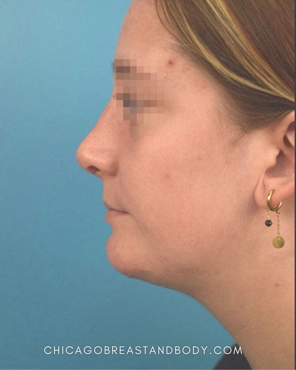 Chicago Breast & Body Aesthetics rhinoplasty after — Chicago, IL