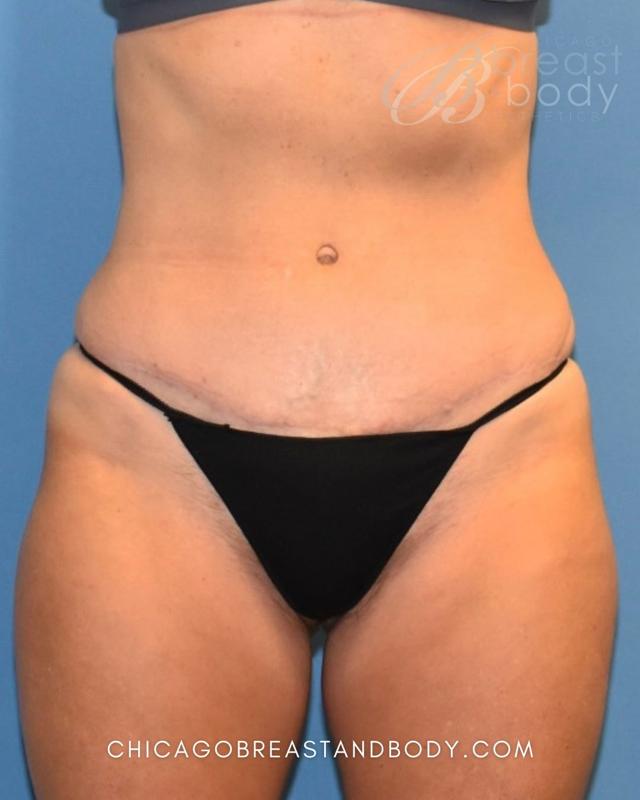 Mini Tummy Tuck after at Chicago Breast & Body Aesthetics in Chicago, IL