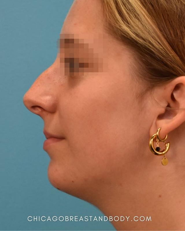 Functional Rhinoplasty before at Chicago Breast & Body Aesthetics in Chicago, IL