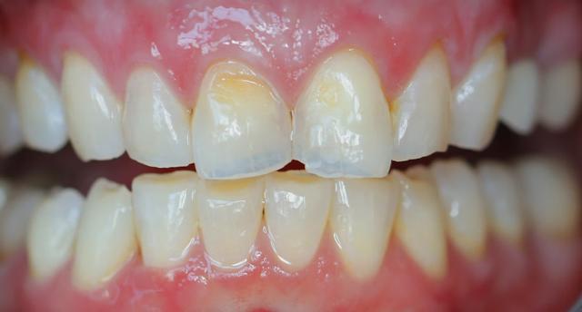 Smile Makeover before at Icon Dentistry in Orem, UT