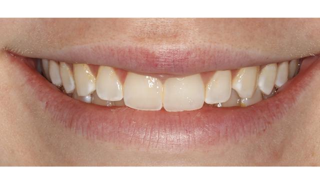 Dental Veneers before at Icon Dentistry in Orem, UT