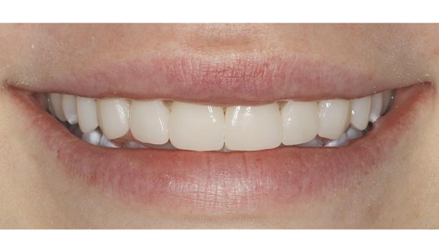 Dental Veneers after at Icon Dentistry in Orem, UT