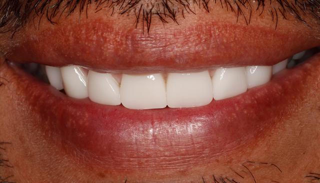 Dental Veneers after at Icon Dentistry in Orem, UT