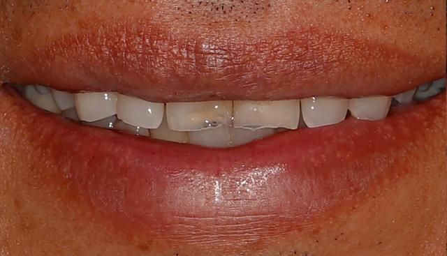 Dental Veneers before at Icon Dentistry in Orem, UT