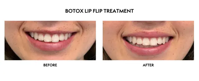 Botox result at ICON Dermatology and Aesthetics in North Bethesda, MD