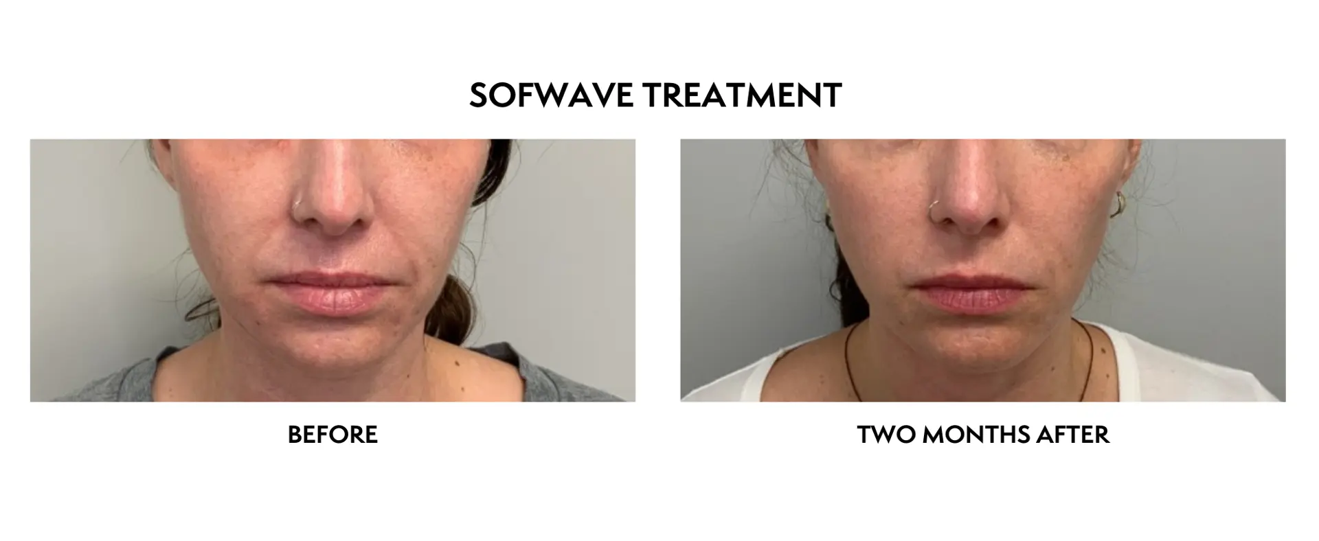 ICON Dermatology and Aesthetics skin tightening result — North Bethesda, MD