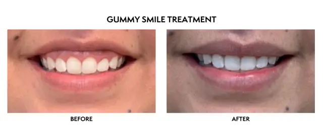 Botox result at ICON Dermatology and Aesthetics in North Bethesda, MD