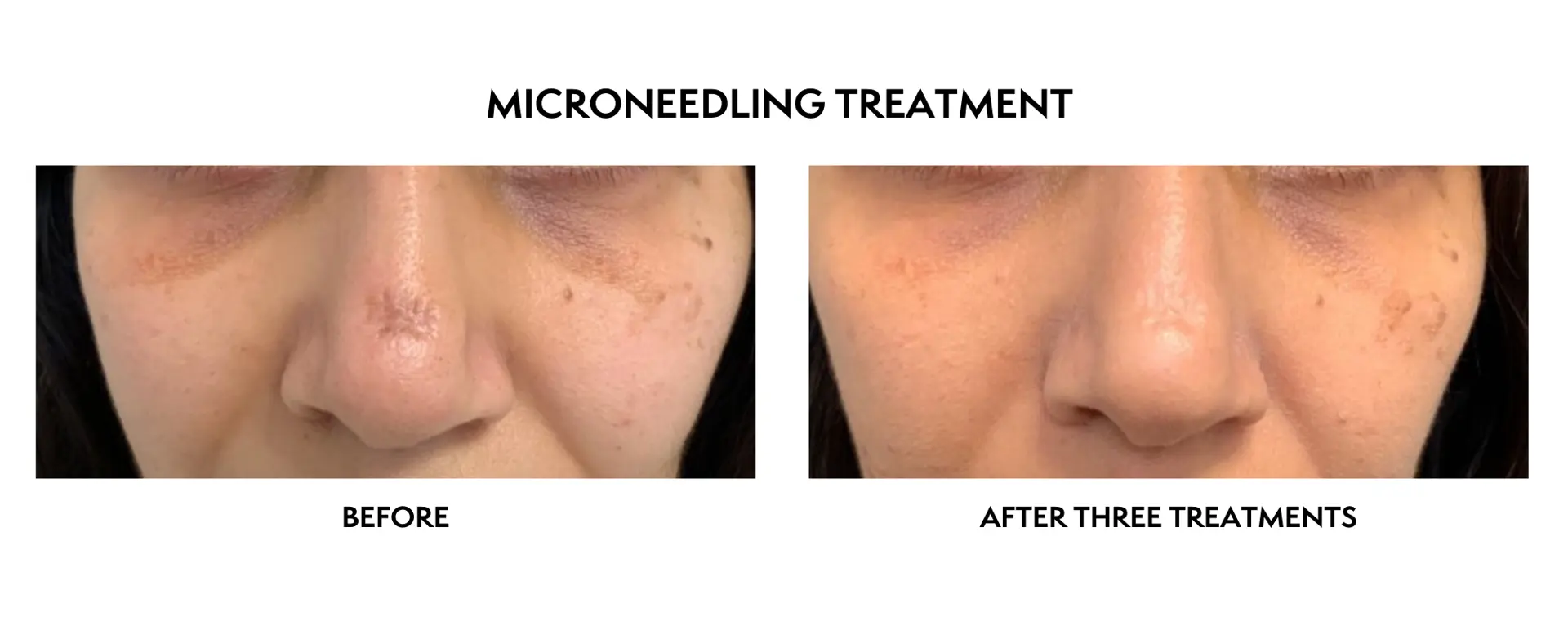 ICON Dermatology and Aesthetics microneedling result — North Bethesda, MD