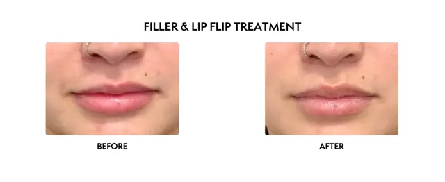 Jawline Filler result at ICON Dermatology and Aesthetics in North Bethesda, MD