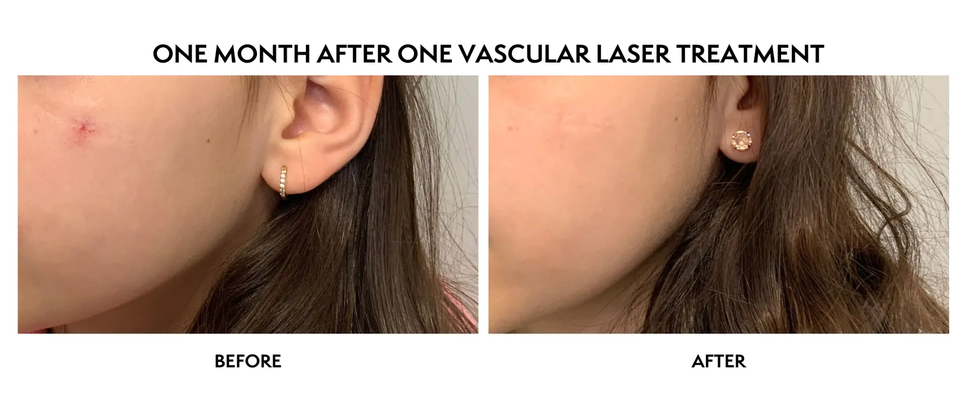 ICON Dermatology and Aesthetics laser treatment result — North Bethesda, MD