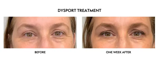 Botox result at ICON Dermatology and Aesthetics in North Bethesda, MD