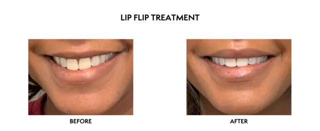 Botox result at ICON Dermatology and Aesthetics in North Bethesda, MD
