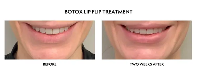 Botox result at ICON Dermatology and Aesthetics in North Bethesda, MD