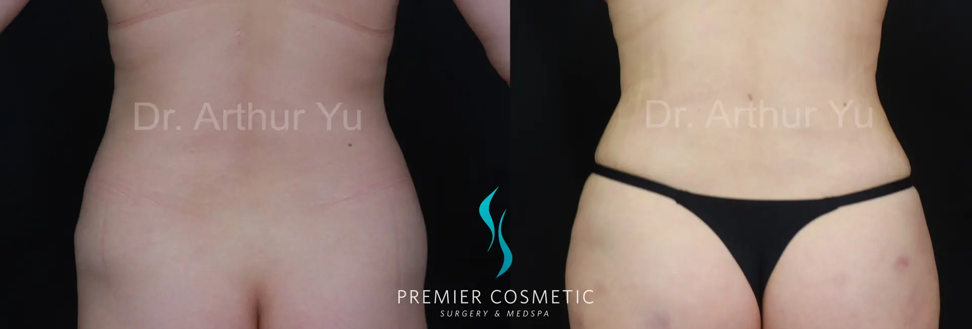 Premier Cosmetic Surgery & Med Spa body contouring result — Arcadia, CA