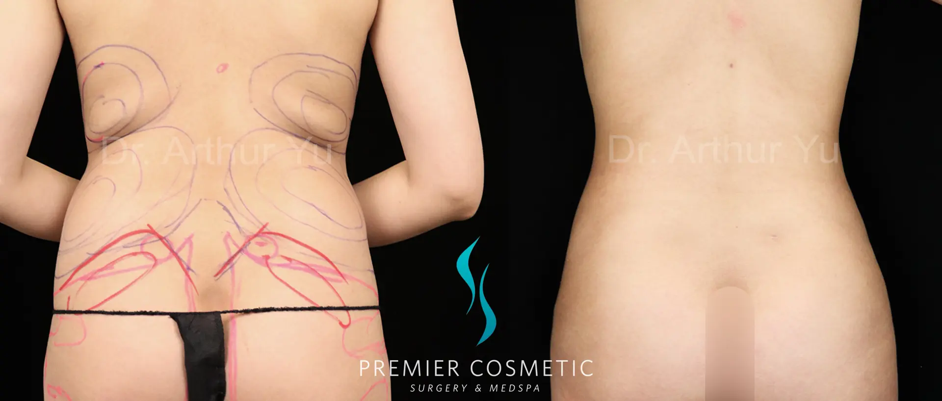 Premier Cosmetic Surgery & Med Spa body contouring result — Arcadia, CA