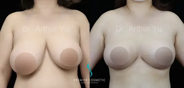 Breast Reduction result at Premier Cosmetic Surgery & Med Spa in Arcadia, CA