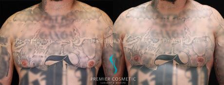 Breast Lift result at Premier Cosmetic Surgery & Med Spa in Arcadia, CA