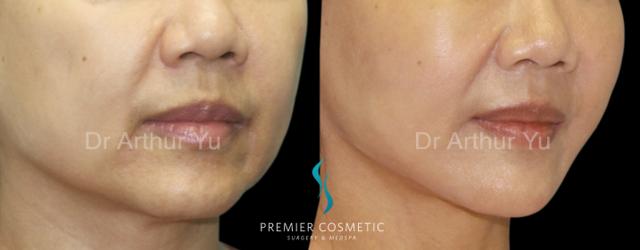 Chin Implant result at Premier Cosmetic Surgery & Med Spa in Arcadia, CA