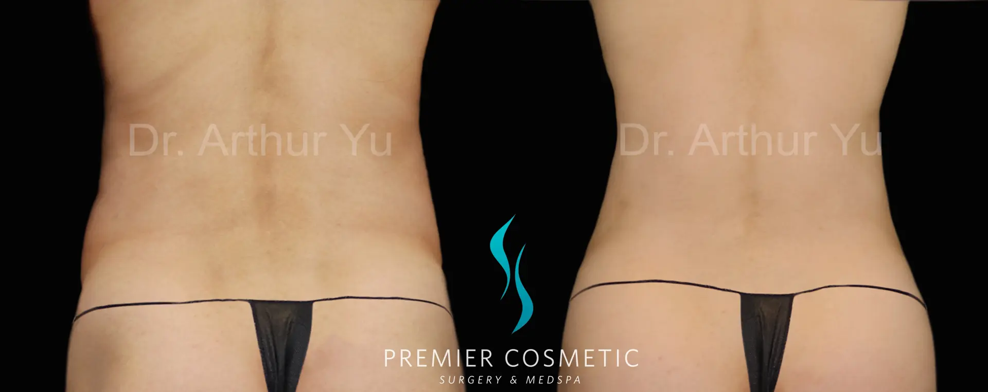 Premier Cosmetic Surgery & Med Spa body contouring result — Arcadia, CA