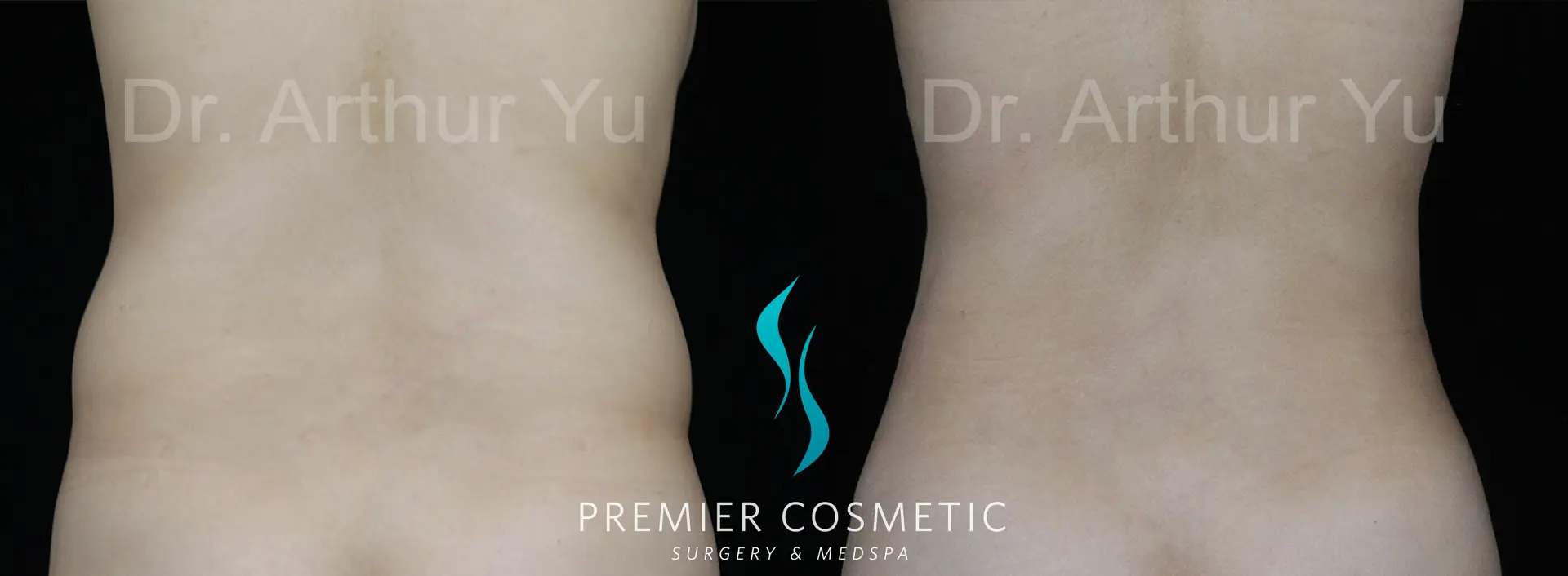 Premier Cosmetic Surgery & Med Spa body contouring result — Arcadia, CA