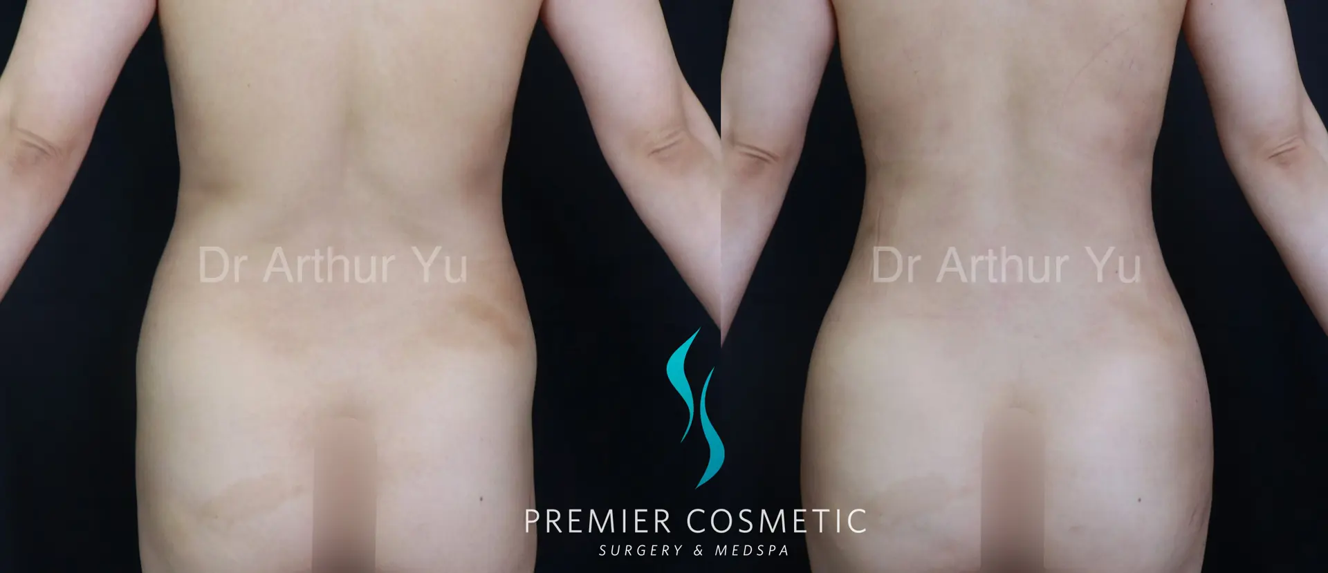 Premier Cosmetic Surgery & Med Spa body contouring result — Arcadia, CA