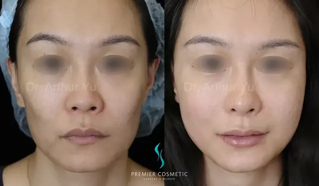 Juvederm result at Premier Cosmetic Surgery & Med Spa in Arcadia, CA