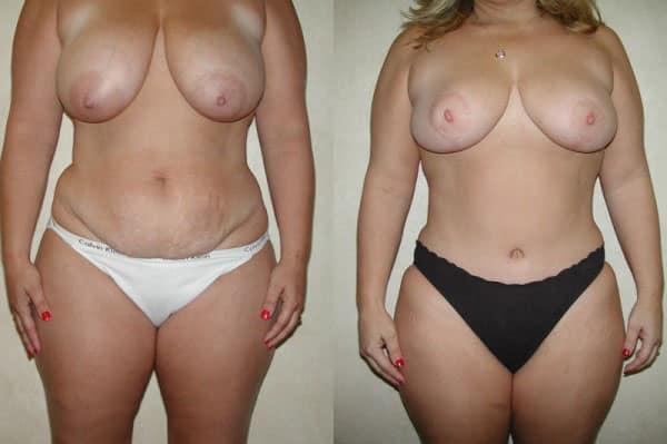 Tummy Tuck result at Richard A. Bartlett M.D., P.C. in Brookline, MA