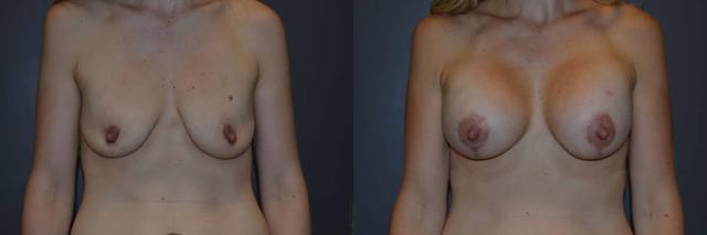 Breast Lift result at Richard A. Bartlett M.D., P.C. in Brookline, MA