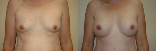 Breast Augmentation result at Richard A. Bartlett M.D., P.C. in Brookline, MA
