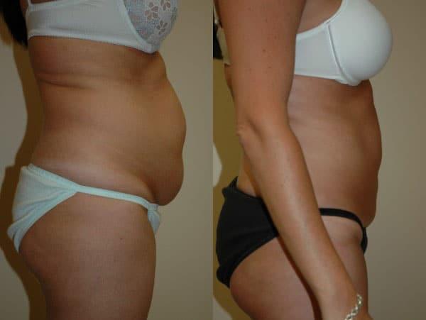 Liposuction result at Richard A. Bartlett M.D., P.C. in Brookline, MA
