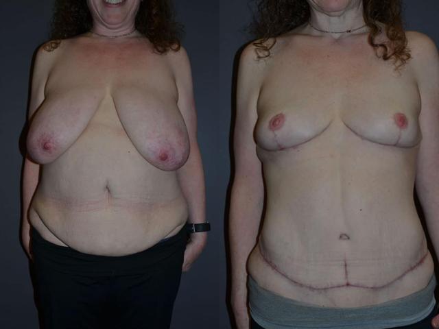 Tummy Tuck result at Richard A. Bartlett M.D., P.C. in Brookline, MA
