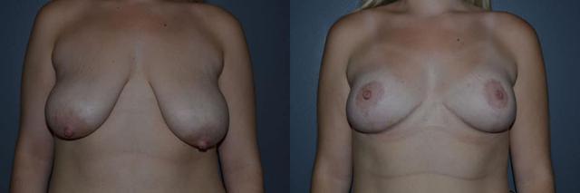 Breast Lift result at Richard A. Bartlett M.D., P.C. in Brookline, MA